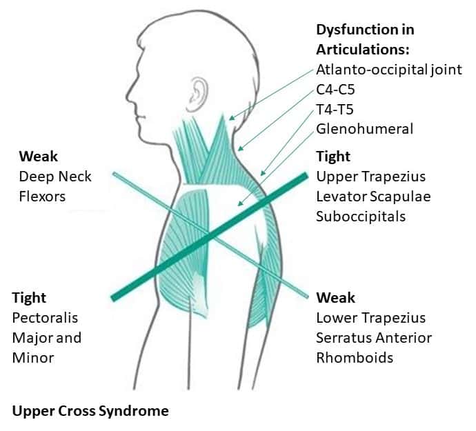 upper cross syndrome posture therapy
